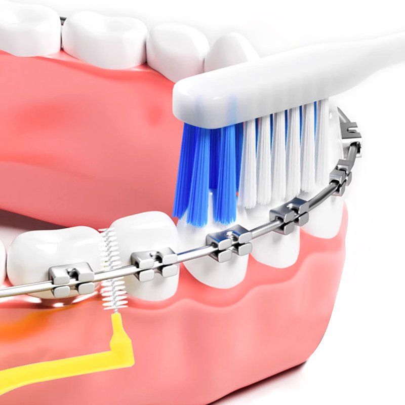 Interdental Brush 14 Interdental brush orthodontics